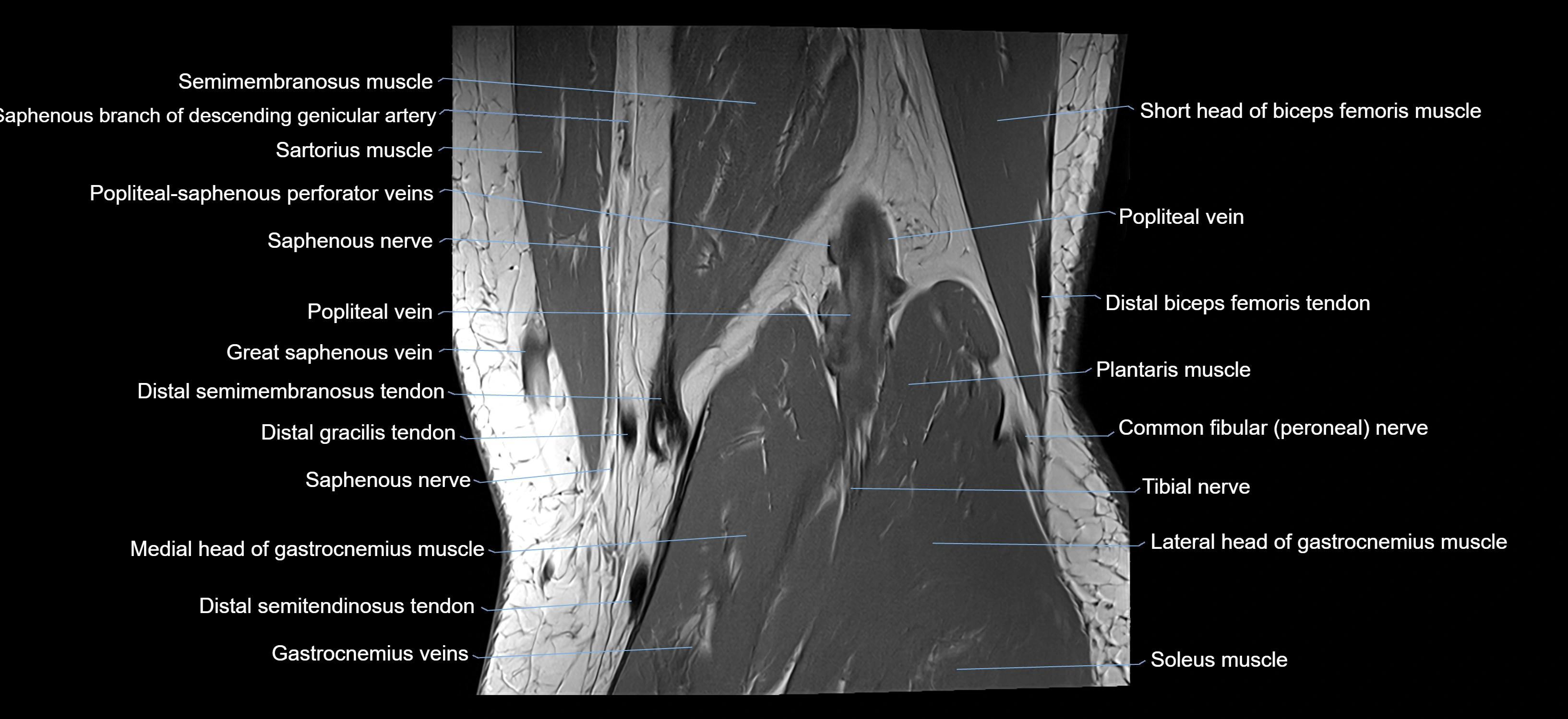 MRI knee coronal cross sectional anatomy labelled 3T radiology  image-04001-00034.webp